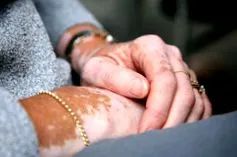 potrivi vitiligo