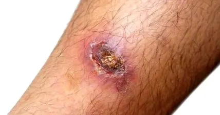 ulcer unui