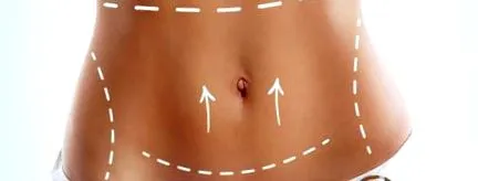 abdominoplasztika