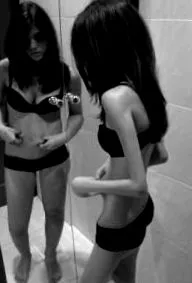 anorexia serdülők