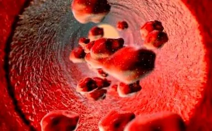 anemia