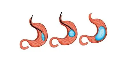 gastric