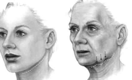 хијалуронска киселина