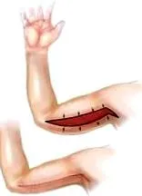 рака