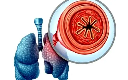 COPD-ben szenvedők