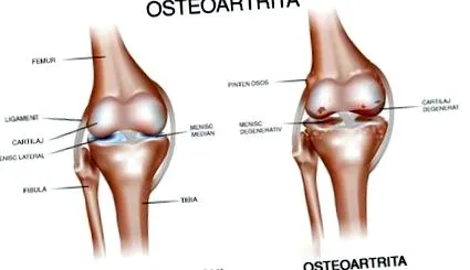 osteoarthritis számára