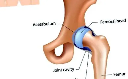 coxarthrosis