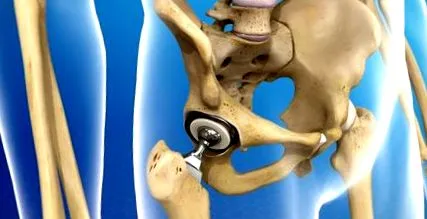 coxarthrosis