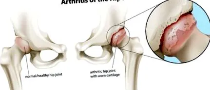 osteoarthritis