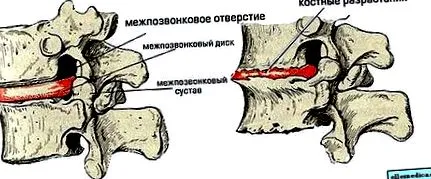 остеохондроза които