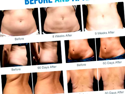 fogyás cryolipolysis