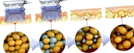 blue cryolipolysis