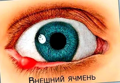 излечи