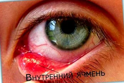 излечи