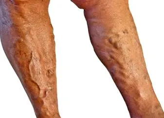 visszerek visszerek