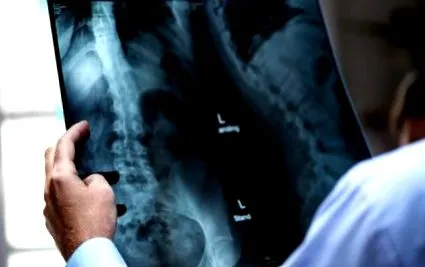 coccyx területén kezelési