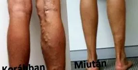 detralex