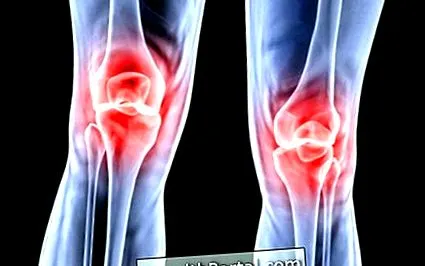 genunchiului osteoartrita
