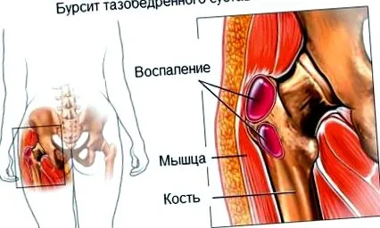 деформиращ тазобедрените