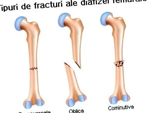femur femur