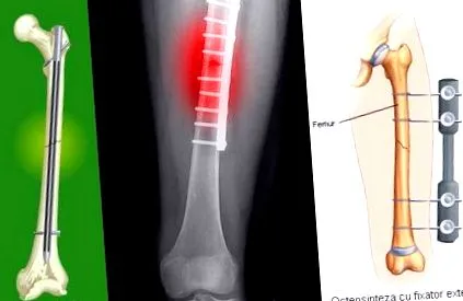 femur femur