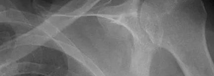 acromion