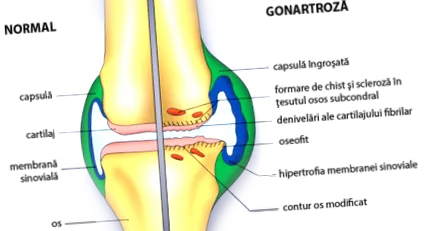 osteoarthritis sürgősségi