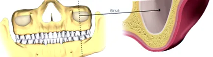 implantátum