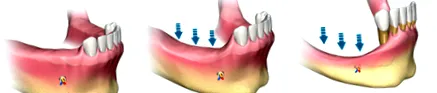 implantátum