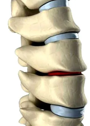 disc