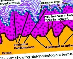 hyperkeratosis