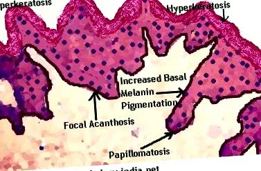 hyperkeratosis