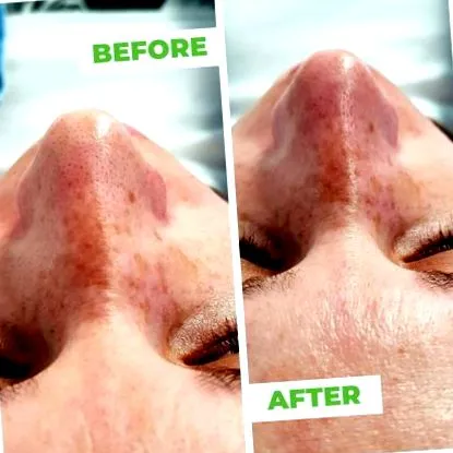 hydrafacial arckezelés