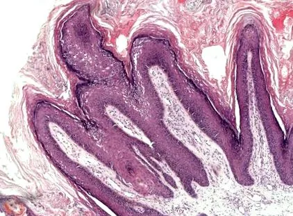 papillomatosis