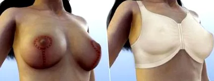 implantátum