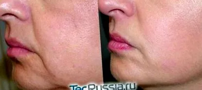слабеење масно ткиво