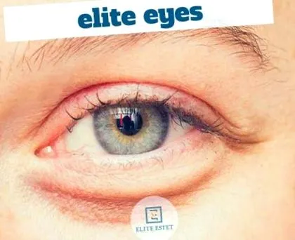 elite szememelés