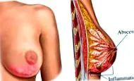 mastitis