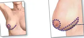 mastopexy