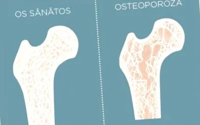 osteoporosisának