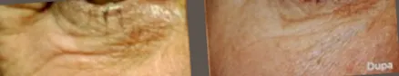 lipolízis mezoterápia