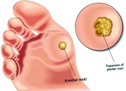 pectoris angina