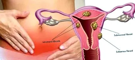 fibroidy použité