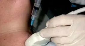 јазли тироидната жлезда