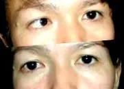 művelet strabismus