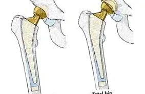 véleményekről osteoarthritis