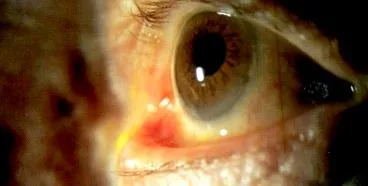 ectropion