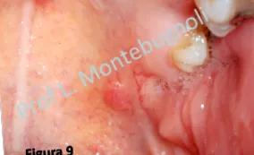 papilloma vírus