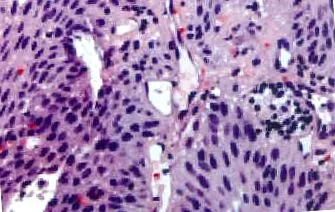 urothelialis hólyag