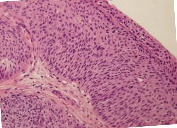 papilloma urothelialis